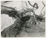 Photograph of Surgical Procedure To Remove Meningioma