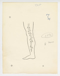Illustration, p. 73: “Varicose Veins #3 and #4” Drawing of Vein in Leg by Medical Arts Publishing Foundation