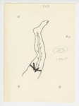 Illustration, p. 75: “Varicose Veins #17” Drawing of Vein in Leg by Medical Arts Publishing Foundation